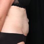 Tummy Tuck Before & After Patient #34348
